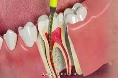 میزان دوام دندان ها پس از عصب کشی