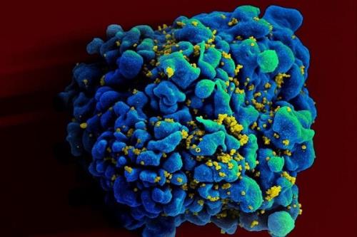 ویروس HIV فرآیند پیری بدن را تسریع می کند