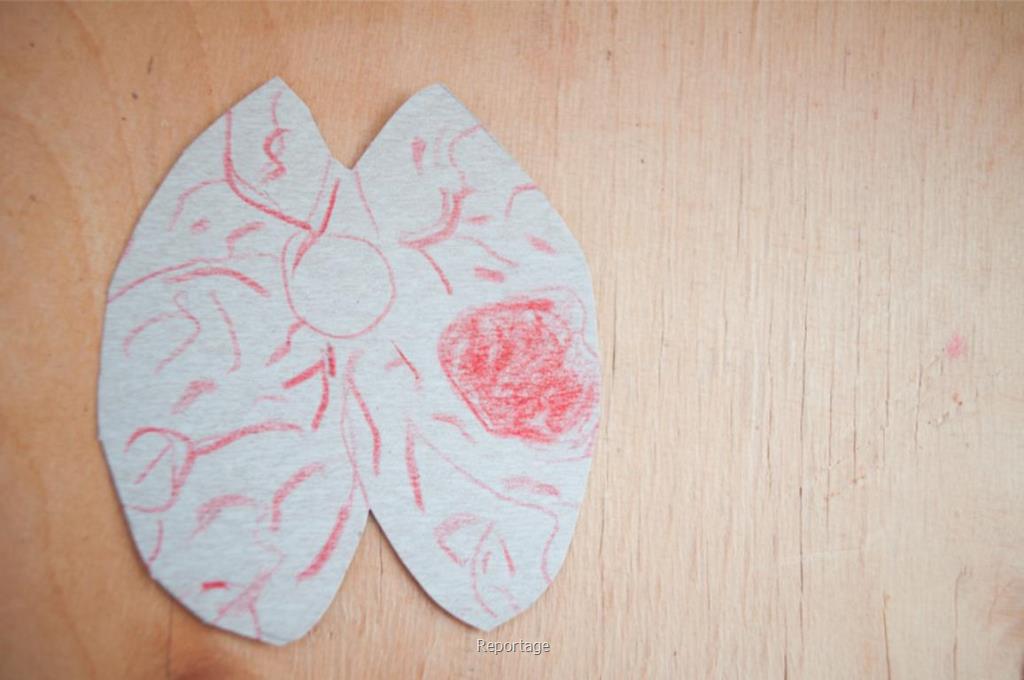 سرطان مغز چیست