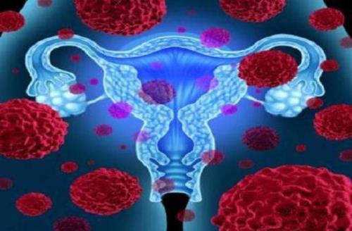 سندرم تخمدان پلی کیستیک و افزایش عوارض قلبی در زنان آبستن