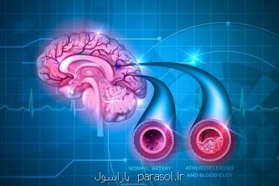 داروهای ضدتهوع ریسک سکته مغزی را می افزایند