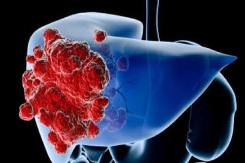 علایم سرطان کبد چیست؟