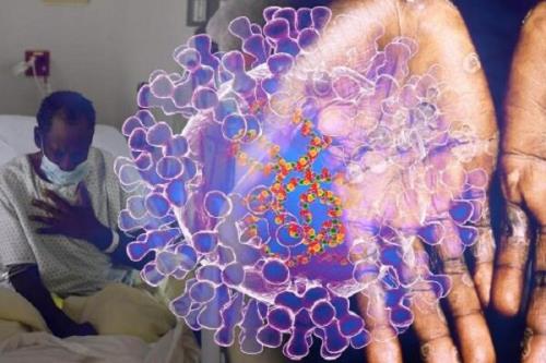 افراد HIV در معرض مبتلا شدن به شدیدترین نوع آبله میمونی