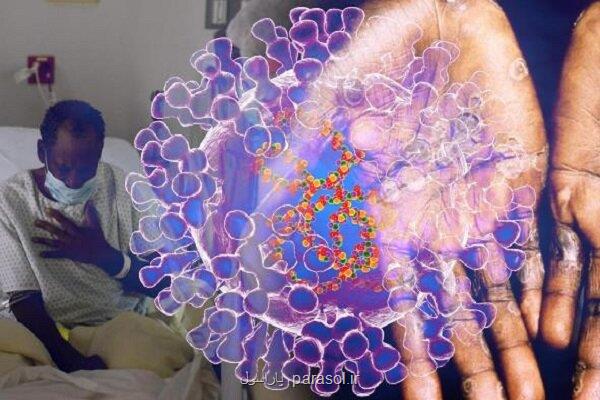 افراد HIV در معرض مبتلا شدن به شدیدترین نوع آبله میمونی