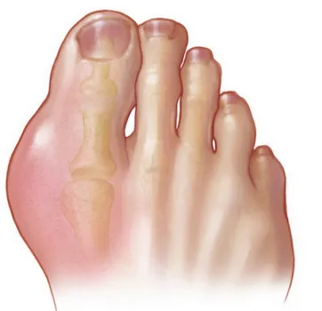 نقرس چیست و درمان اصولی آن چطور است؟