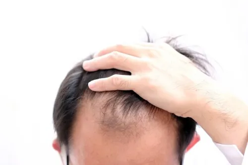 دلیلهای شایع ریزش مو