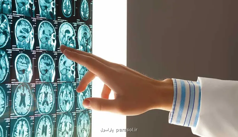 این گروههای خونی بیشتر در معرض سکته مغزی در سنین پائین هستند