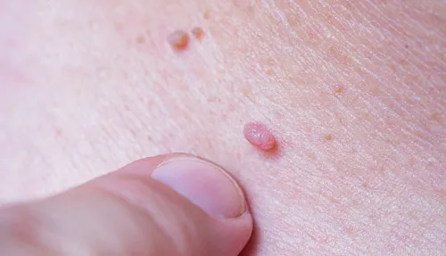 ویروس زگیل از باشگاه ورزشی منتقل می شود؟