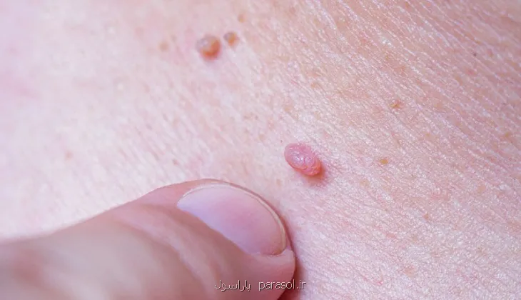 ویروس زگیل از باشگاه ورزشی منتقل می شود؟
