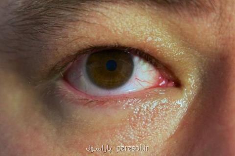 ویروس هپاتیت B باعث از بین رفتن بینایی می گردد