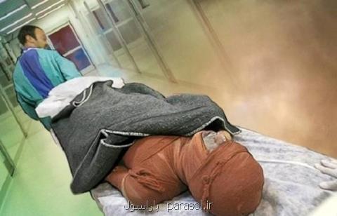 سوختگی سالانه 180 هزار ایرانی، 3000 نفر جان می بازند