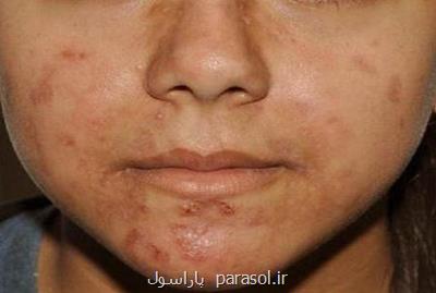 بیماران مبتلا به آكنه در معرض ریسك بالای افسردگی